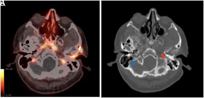 Revisiting Skull Metastases of Prostate Cancer at Prostate-Specific Membrane Antigen (PSMA) Positron Emission Tomography/Computed Tomography Era: PSMA Uptake Characteristics and Oncological Outcomes.