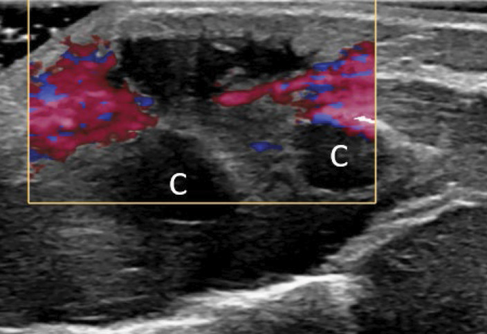 SELSTOC: Self‑Limiting Sternal Tumour of Childhood.