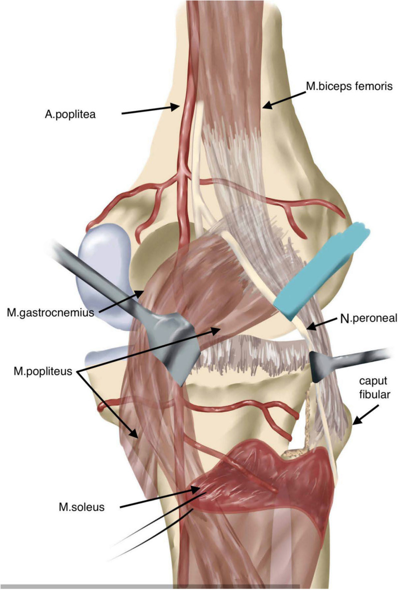 Fibular head osteotomy: A new technique for better exposure of postero-lateral tibial plateau fracture.