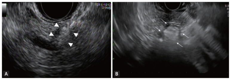 Role of endoscopic ultrasound in the diagnosis and local ablative therapy of pancreatic neuroendocrine tumors.