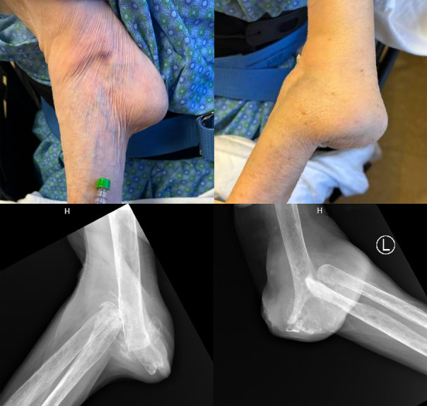 Clinical Images: Flail elbows: destructive calcium pyrophosphate crystal arthritis.