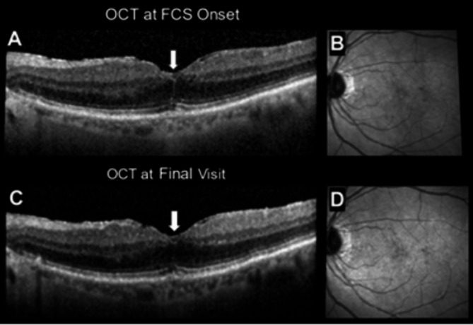 Foveal crack sign and macular pattern dystrophy.
