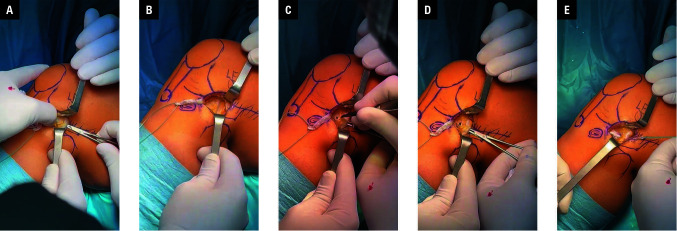 Functional outcomes of simultaneous anterior cruciate ligament reconstruction and lateral extra-articular tenodesis using an all-suture anchor: a modified mini-open technique.