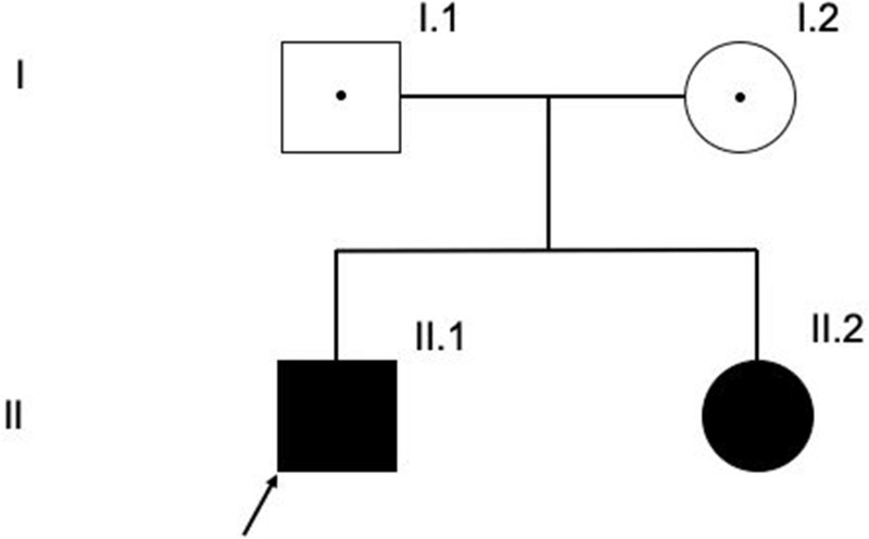 Acrodermatitis Continua of Hallopeau and Generalised Pustular Psoriasis: Case Reports of Two Different Manifestations of IL36RN Mutation in Siblings.