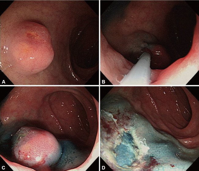 Long-Term Outcomes in Patients With Non-Ampullary Duodenal Neuroendocrine Tumors.