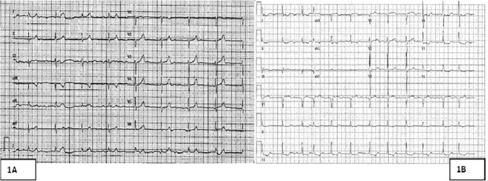 Simultaneous Treatment of Two Severe Acute Intoxication and Acute Kidney Injury.