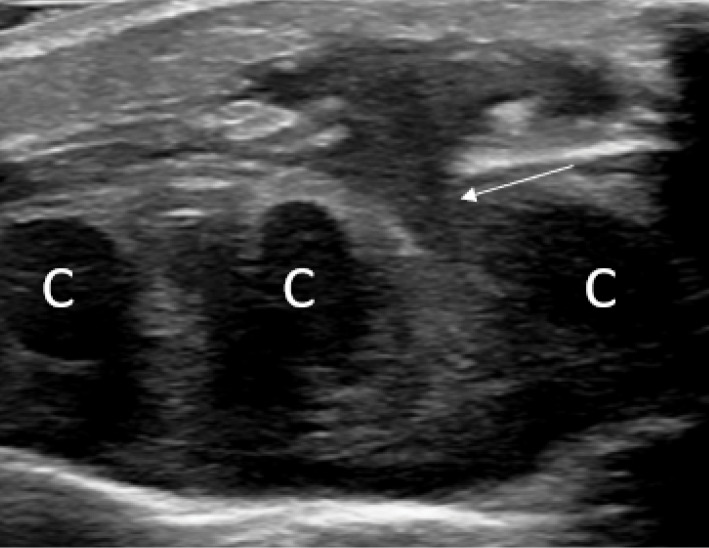 SELSTOC: Self‑Limiting Sternal Tumour of Childhood.