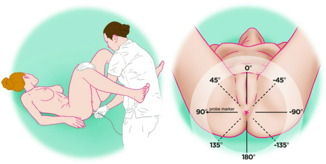 Detection of obstetric anal sphincter injuries using machine learning-assisted impedance spectroscopy: a prospective, comparative, multicentre clinical study.