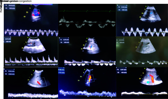 Cracking the Code of AKI: Evaluating the Predictive Power of VExUS Scoring in Critically Ill Noncardiac Patients.