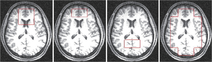 Diminished Compensatory Energy Production Following Hypoxic Stress in the Prefrontal and Anterior Cingulate Cortex Among Individuals With Schizophrenia.