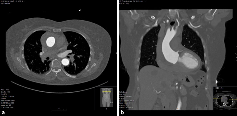 Sudden onset chest pain after a CT-scan of the aorta.