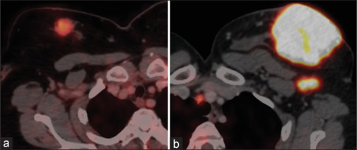 Metabolic Imaging Parameters of <sup>18</sup>F FDG PET/CT in Differentiating the Ki-67 Index in Carcinoma Breast.