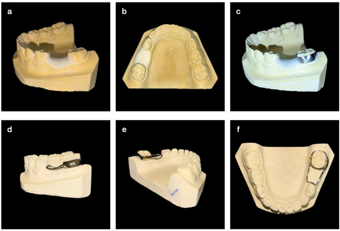 Conventional vs. 3D printed band and loop space maintainers: a fracture strength analysis.