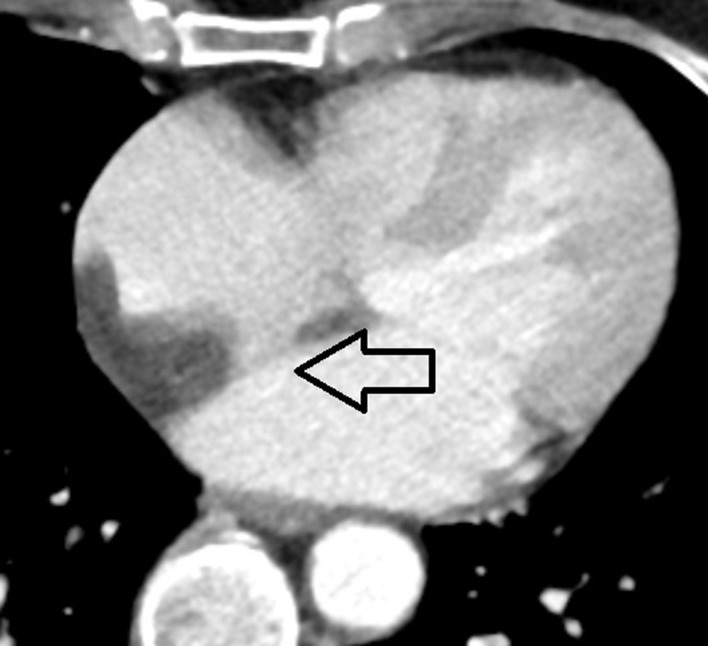 Lipomatous Hypertrophy of the Interatrial Septum.