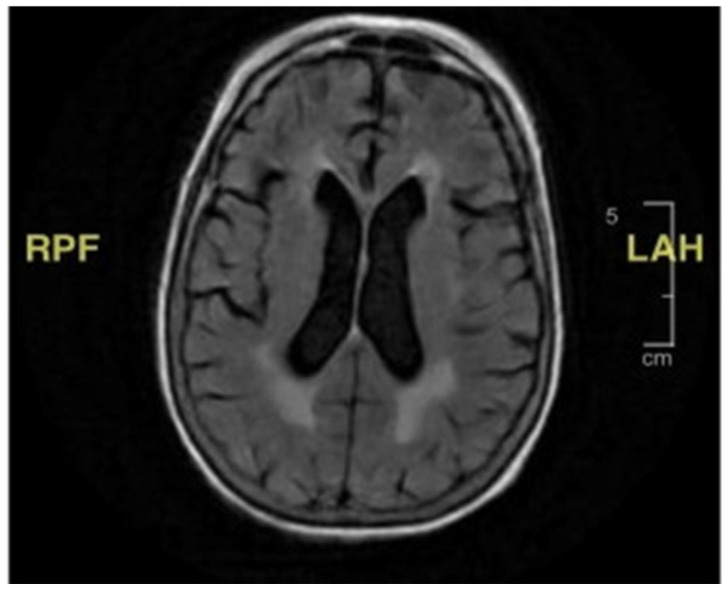 Case Report: Weakness and Recurrent Falls in an Older Patient.