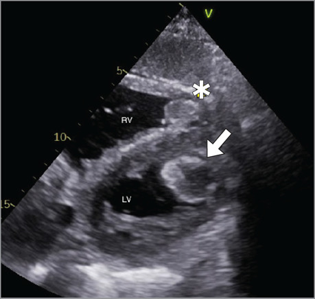Effective Thrombectomy for Biventricular Thrombosis With an Endoscope via the Aortic and Tricuspid Heart Valves.