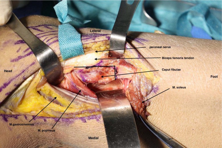 Fibular head osteotomy: A new technique for better exposure of postero-lateral tibial plateau fracture.
