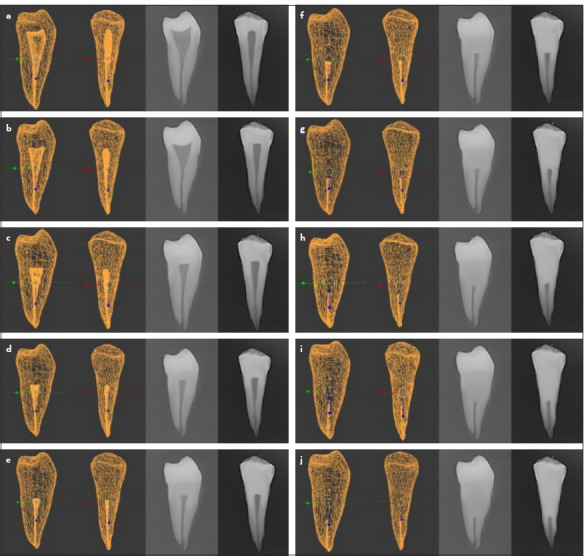 Effectiveness of a 3D Printed Training Kit for the Preparation of Access Cavities in Calcified Teeth: A Pilot Study.