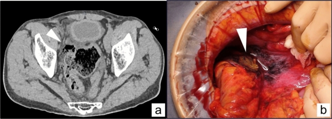 A proactive technique for reversal of Hartmann's procedure: lifting the rectal stump to the abdominal wall.