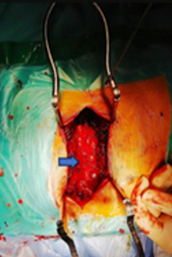 Thoracic cavernous hemangioma mimicking an epidural neurinoma in an hourglass shape: a case report and review of the literature.