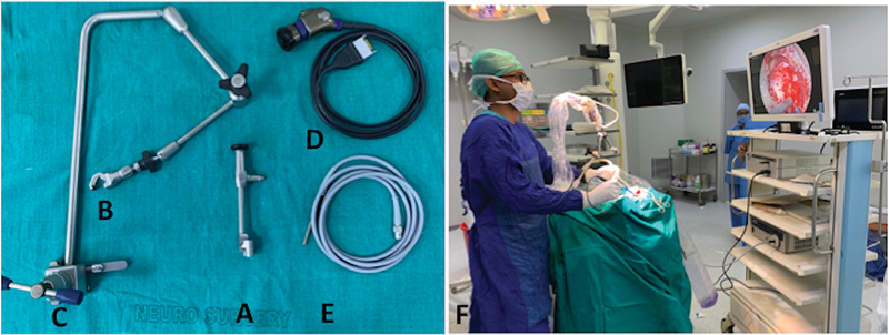 Exoscopic Supraorbital Keyhole Approach for Skull Base Lesions: An Institutional Experience.
