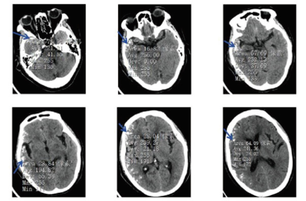 [Brain and Meningeal Metastases of Lung Cancer Manifested as Brain Calcifications:  A Case Report and Literature Review].