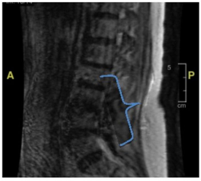 Case Report: Weakness and Recurrent Falls in an Older Patient.