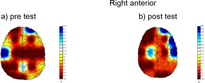 Transcranial direct current stimulation associated with physical exercise can help smokers to quit smoking: a randomized controlled trial.