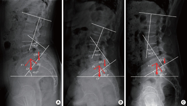 Correlation Between the Spinopelvic Parameters and Morphological Characteristics of Pedicle-Facet Joints in Different Lumbar Spondylolisthesis.