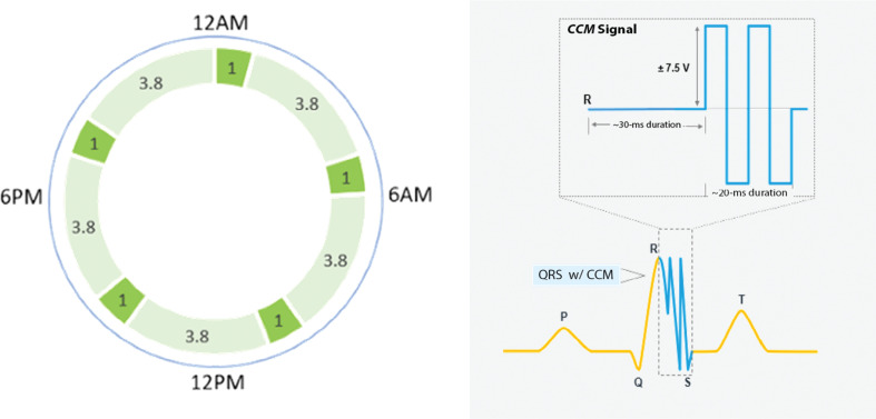 "Optimizing" the Anesthetic for Cardiac Contractility Modulation Devices.
