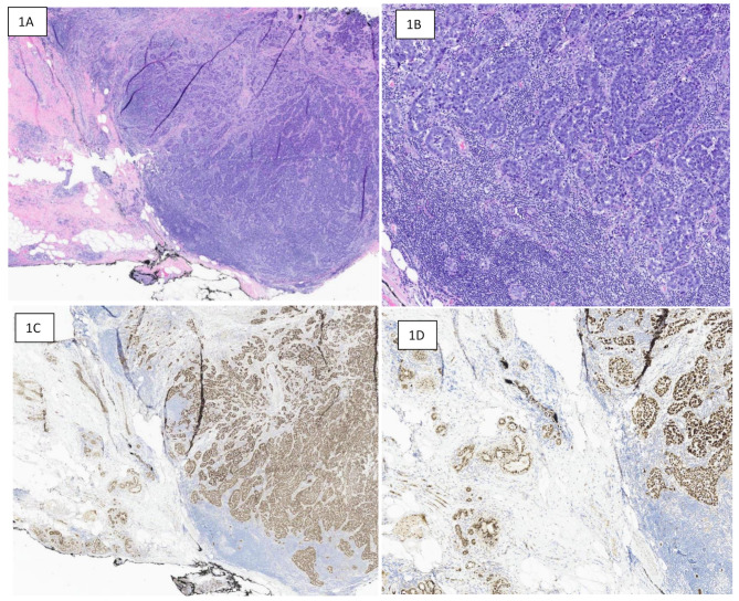 Trichorhinophalangeal syndrome type 1 (TRPS1) in breast pathology: diagnostic utility and pitfalls.