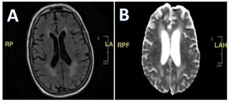 Case Report: Weakness and Recurrent Falls in an Older Patient.