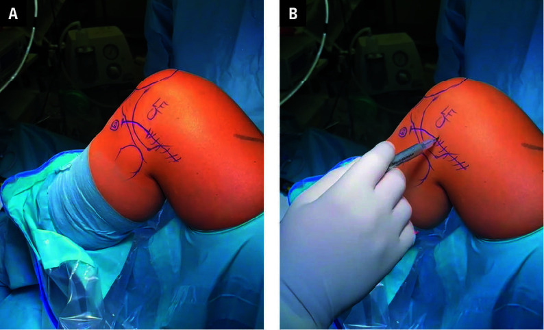 Functional outcomes of simultaneous anterior cruciate ligament reconstruction and lateral extra-articular tenodesis using an all-suture anchor: a modified mini-open technique.