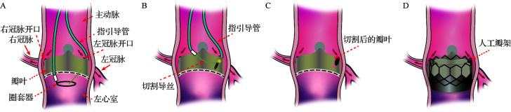 [Risk of coronary obstruction and protection strategies in transcatheter aortic valve replacement].