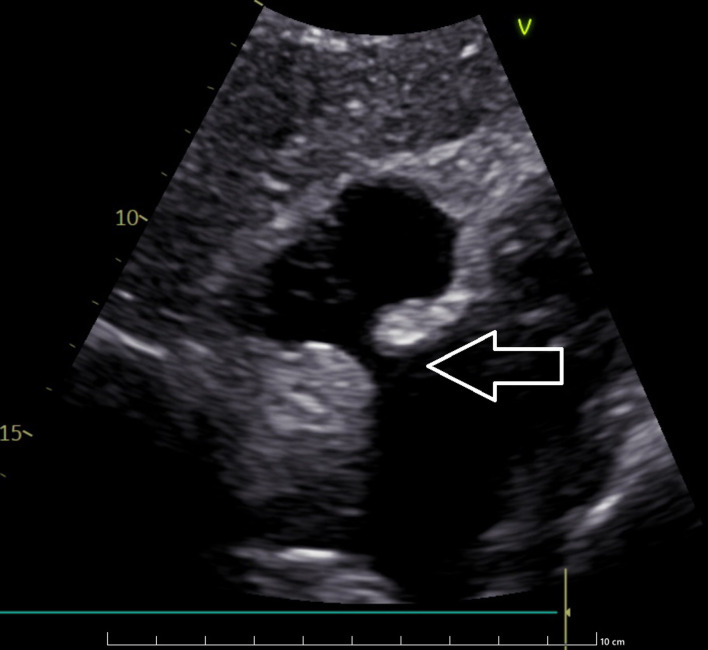 Lipomatous Hypertrophy of the Interatrial Septum.