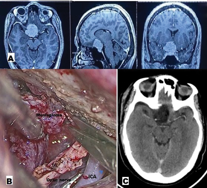 Exoscopic Supraorbital Keyhole Approach for Skull Base Lesions: An Institutional Experience.