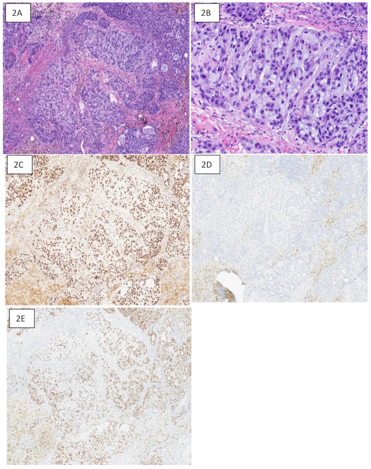 Trichorhinophalangeal syndrome type 1 (TRPS1) in breast pathology: diagnostic utility and pitfalls.
