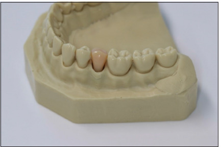 Effectiveness of a 3D Printed Training Kit for the Preparation of Access Cavities in Calcified Teeth: A Pilot Study.