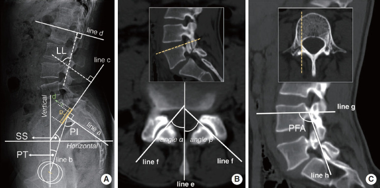 Correlation Between the Spinopelvic Parameters and Morphological Characteristics of Pedicle-Facet Joints in Different Lumbar Spondylolisthesis.