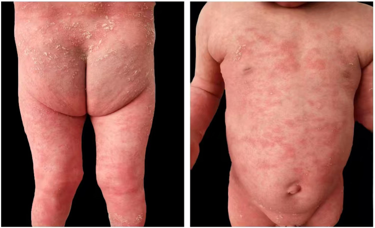 Acrodermatitis Continua of Hallopeau and Generalised Pustular Psoriasis: Case Reports of Two Different Manifestations of IL36RN Mutation in Siblings.