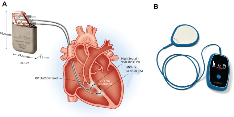 "Optimizing" the Anesthetic for Cardiac Contractility Modulation Devices.