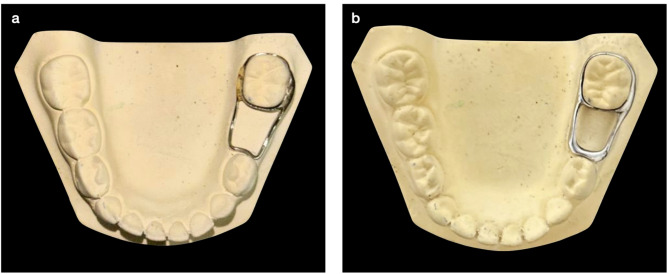 Conventional vs. 3D printed band and loop space maintainers: a fracture strength analysis.