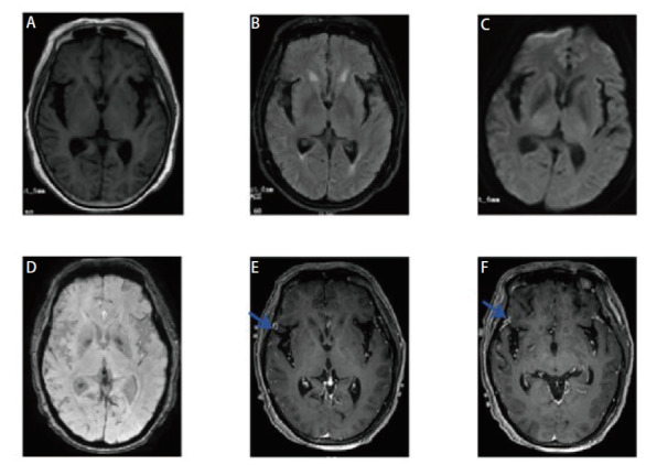 [Brain and Meningeal Metastases of Lung Cancer Manifested as Brain Calcifications:  A Case Report and Literature Review].