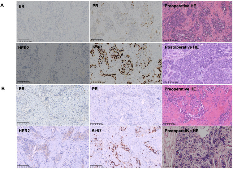 Patient-Derived Organoids for Guiding Neoadjuvant Chemotherapy in Bilateral Primary Breast Cancer: A Case Report.