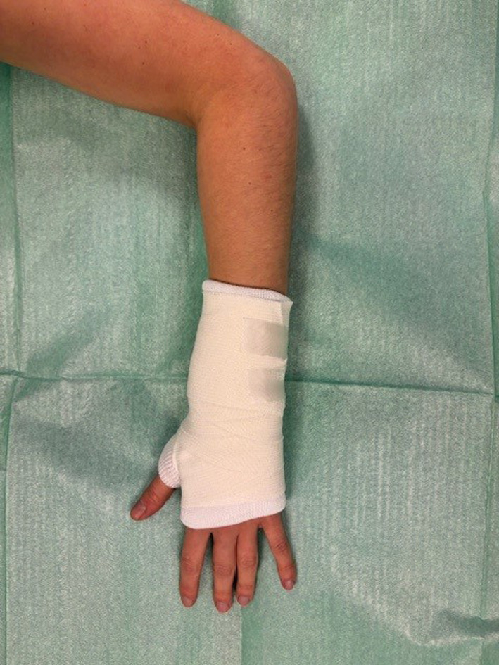 Can we avoid casting for suspected scaphoid fractures? A multicenter randomized controlled trial.