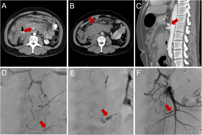 Interventional treatment of peripancreatic aneurysms: can one strategy fit all?