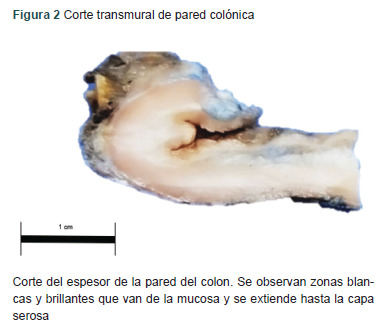 [Colitis cystica profunda induced by radiation 27 years later. Case report].