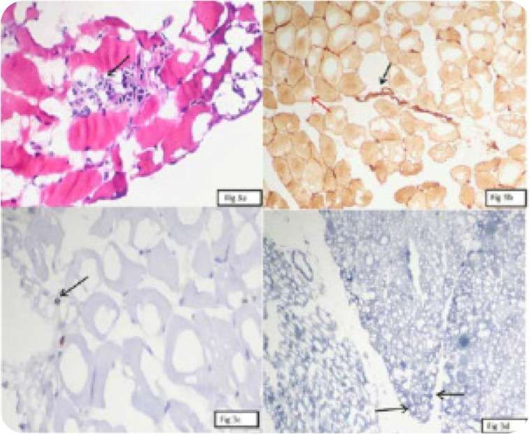 Prevalence of Anti-Synthetase Syndrome in Patients of Interstitial Lung Disease with Connective Tissue Diseases and Autoimmune Features: A Cross-Sectional Study.