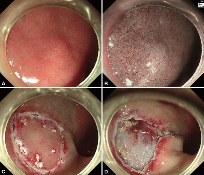 Long-Term Outcomes in Patients With Non-Ampullary Duodenal Neuroendocrine Tumors.