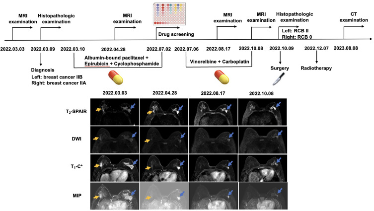 Patient-Derived Organoids for Guiding Neoadjuvant Chemotherapy in Bilateral Primary Breast Cancer: A Case Report.